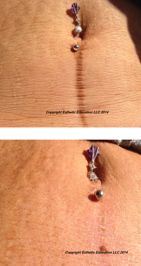 Before and After Micro-needling Treatment