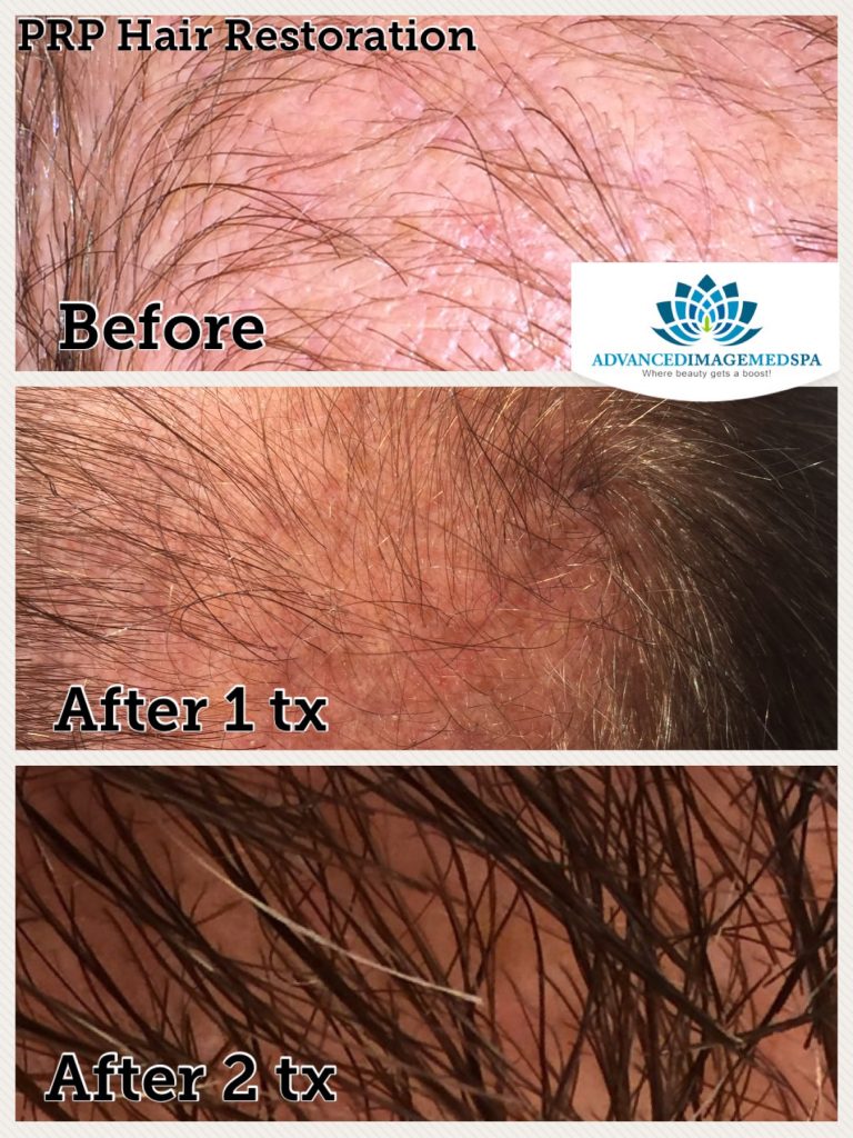 Hair Restoration at Advanced Image Med Spa
