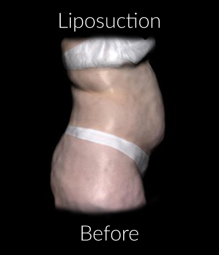Before-Liposuction 1
