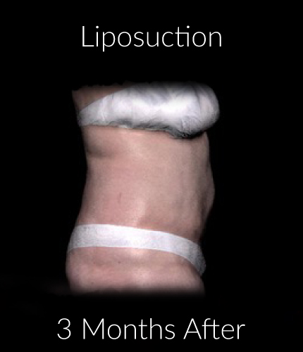 After-Liposuction 3