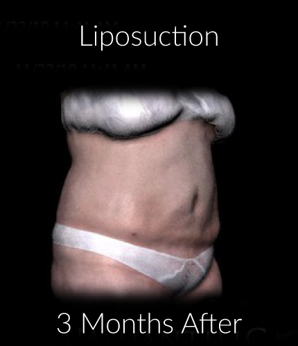 After-Liposuction 4