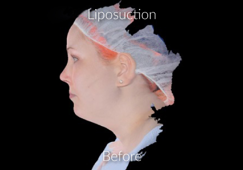 Before-Liposuction 2