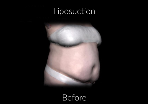 Before-Liposuction 4