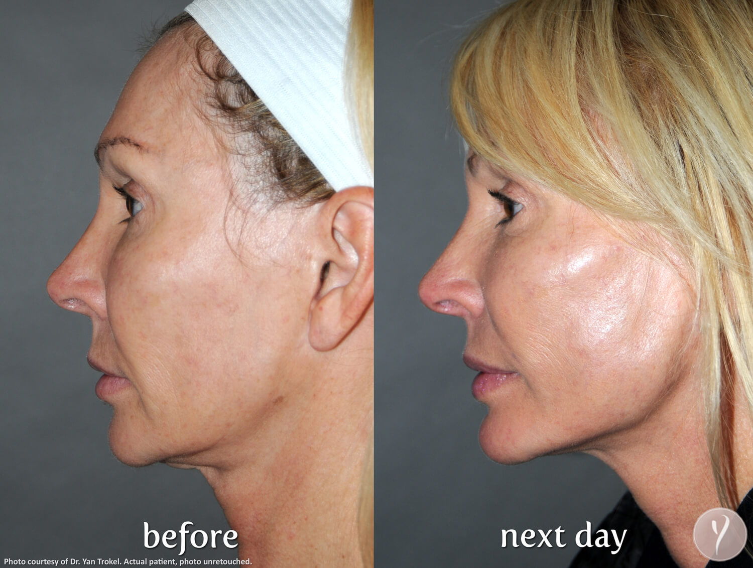 Side profile showing Y Lift treatment results at Advanced Image Med Spa.