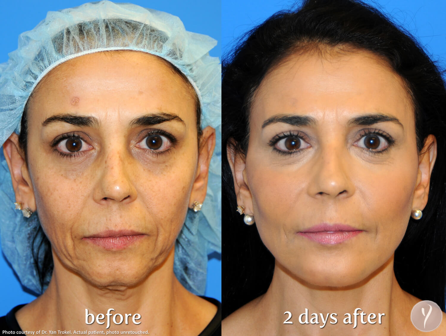 Before and after Y Lift treatment at Advanced Image Med Spa in Glendale, AZ.