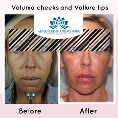 Before and after Juvederm Voluma XC cheek filler at Advanced Image Med Spa.