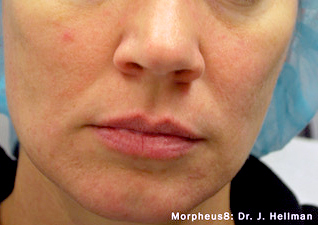 After-RF Micro-Needling