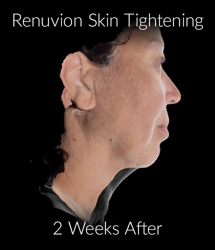 After-Renuvion Skin Tightening