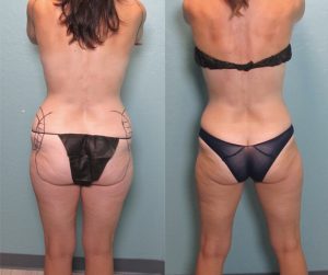 high def liposuction
