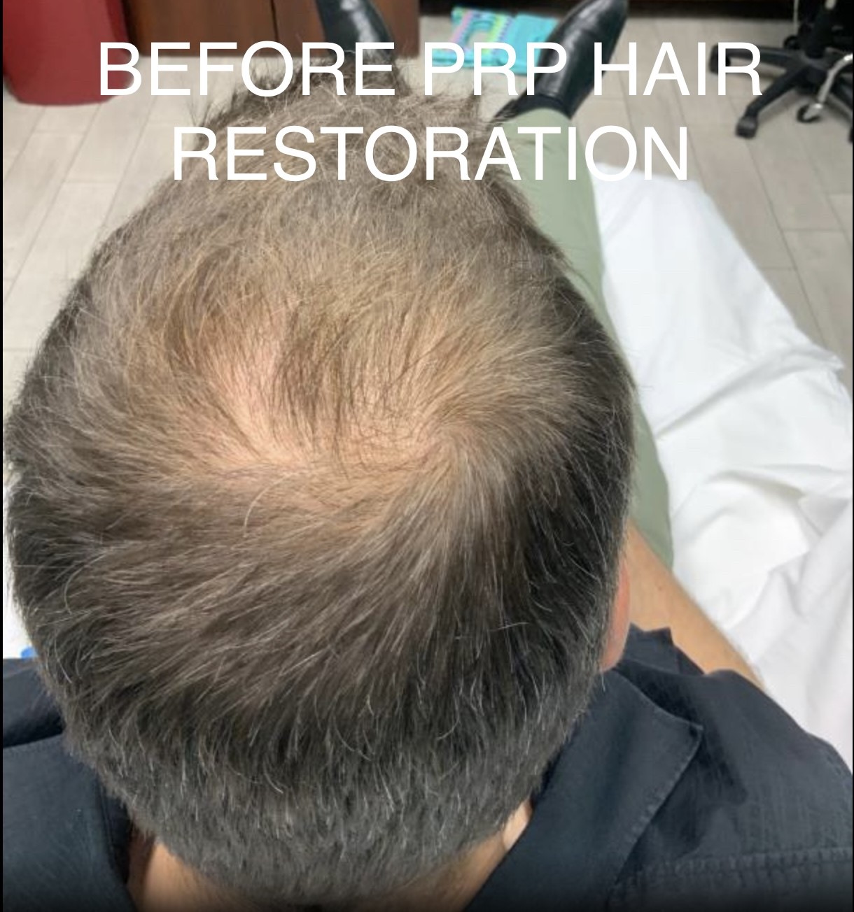 PRP Hair Therapy vs. FUE Hair Transplant and cost in Delhi | Desmoderm