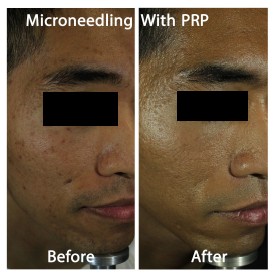 Microneedling and PRP