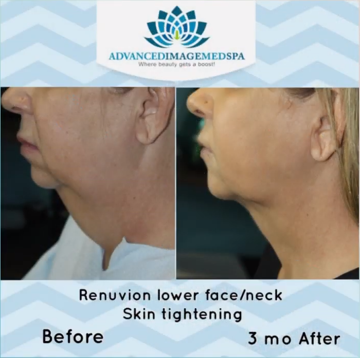 Renuvion Skin Tightening