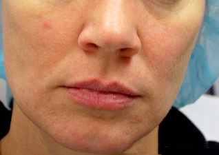 After-RF Micro-Needling