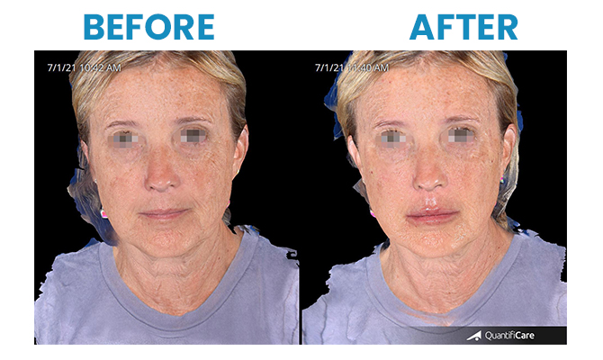 Before and after Juvederm Voluma XC cheek filler at Advanced Image Med Spa, Glendale, AZ.