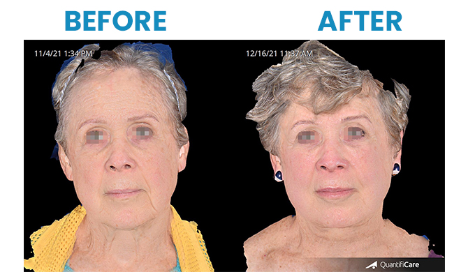 Before and After 2