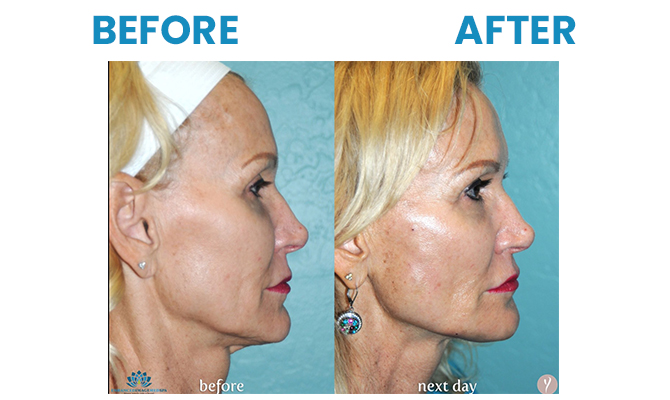 Before and After 4