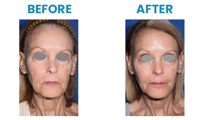 Before and After 6