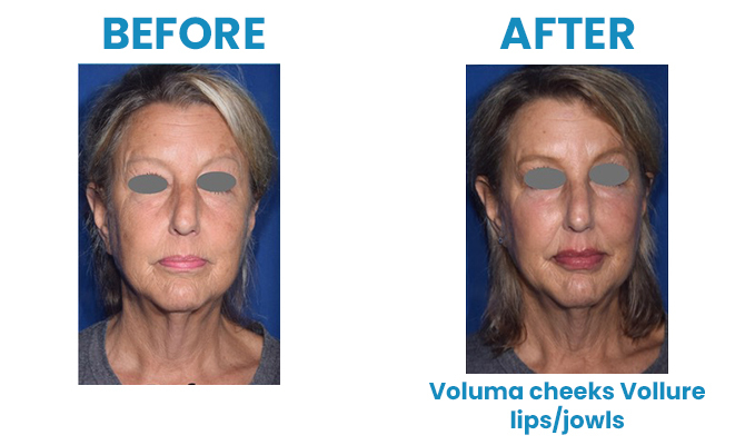Before and After 7